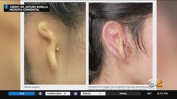 Woman receives 3D-printed ear made of human cells