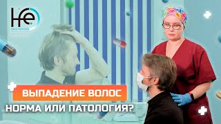 Как определить, что потеря волос перешла из нормы в патологию?