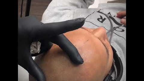 Amazing results of Scalp Micropigmentation by Antonio Baroque     @ Baroque Beauty Center