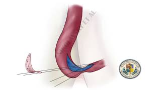 membranous (sphincteric) urethroplasty animation: dorsal onlay BMG