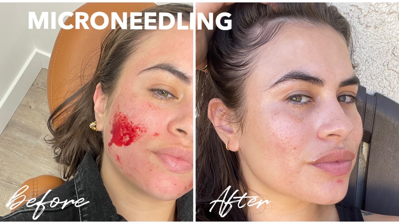 CLEARING UP MY ACNE SCARS + WEEK BY WEEK 1 MONTH POST MICRONEEDLING