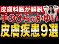 手のひらがかゆい!原因と皮膚疾患9選、手湿疹 の予防法・治療法を皮膚科医が解説