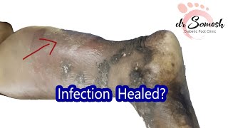 #cellulitis #infection | Necrotizing Fascitis Healing Stages