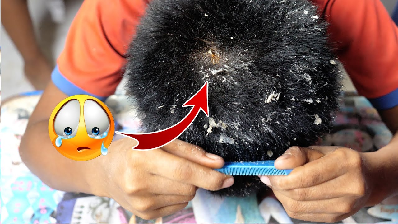 Huge Flake,Dandruff Scratching Big Flakes No Talking Huge Flakes #06