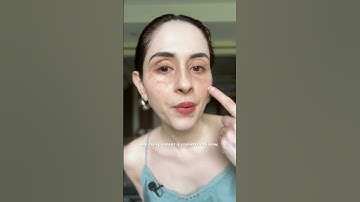 Can you believe this? #vitiligo