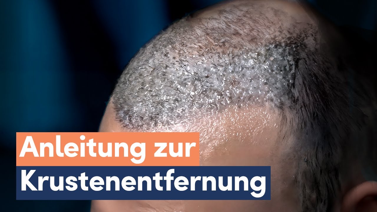 Krusten nach Haartransplantation entfernen! | Anleitung