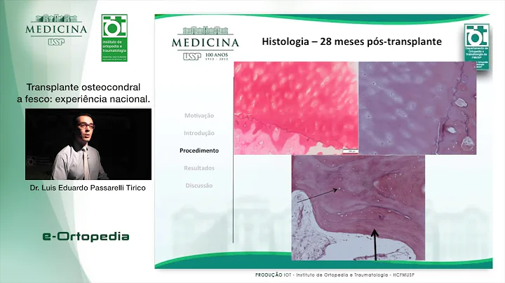 Transplante osteocondral a fesco  experincia nacio...