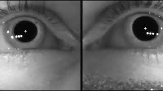 Nystagmus during bow and lean test  Horizontal semicircular canal BPPV