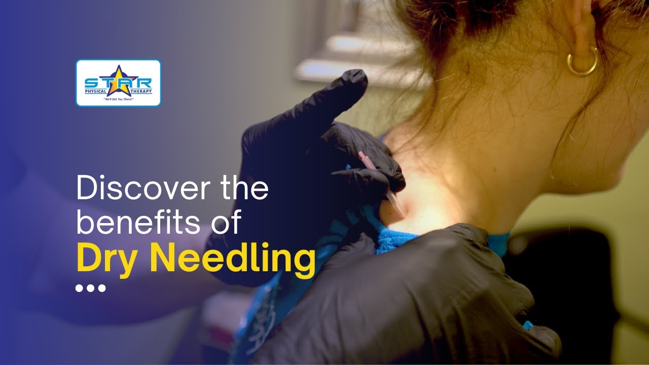 Dry Needling at STAR Physical Therapy
