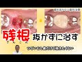 残根だけれど、抜きたくない