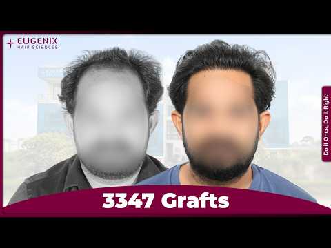 A Hair Transplant That Changed His Perspective | Hemanth’s Story