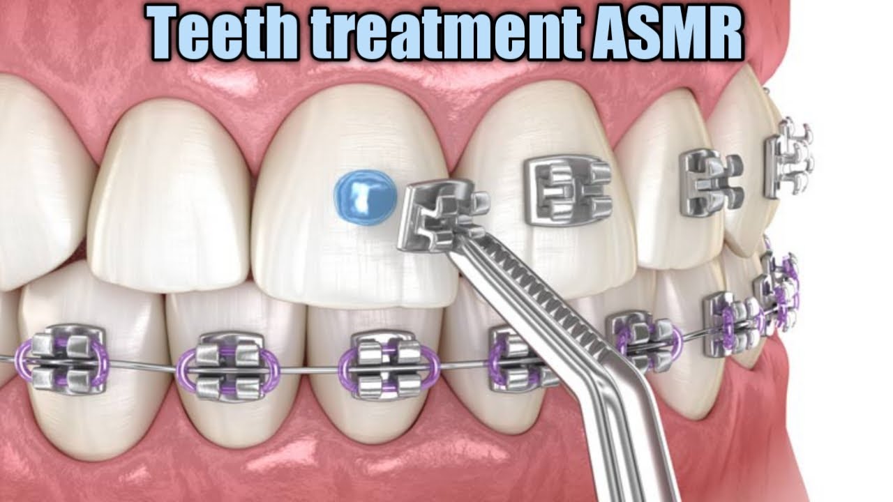 Tooth Relief Animation Animation of teeth treatment ASMR - YouTube