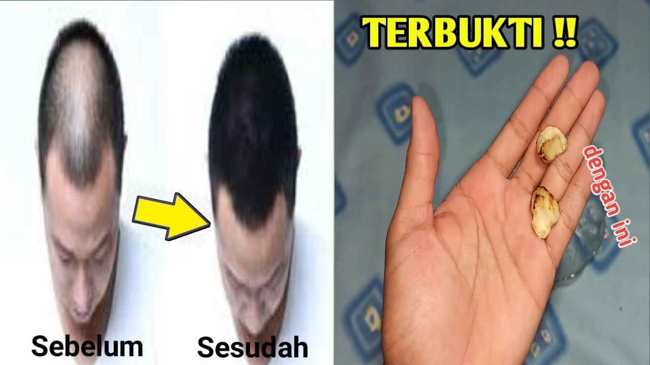 2 Butir Saja !! Rambut Tumbuh Lebat Permanen, Cara