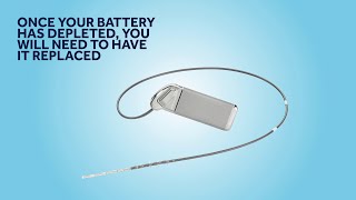 Sacral Neuromodulation (SNM) battery needs replacing: what to expect?