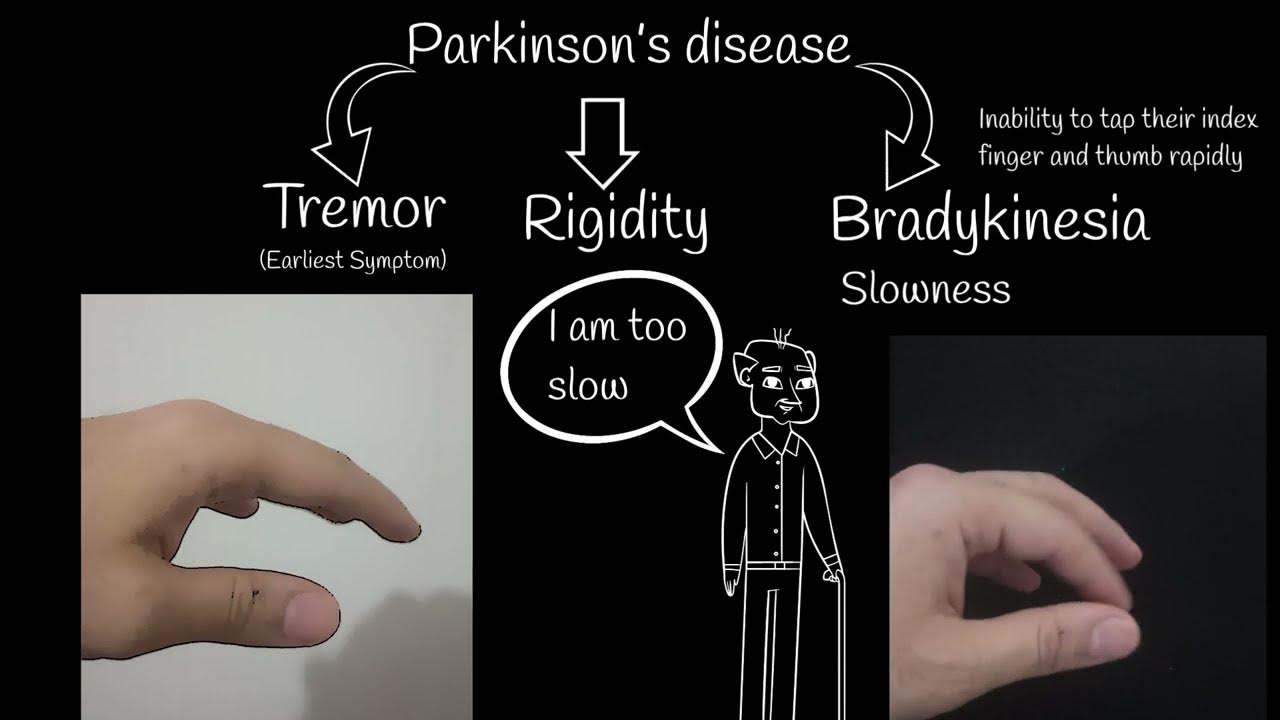 Parkinson's disease First symptoms and treatment. Parkinson's disease