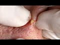 THE MOST STUBBORN BLACKHEADS | Suri Job 136