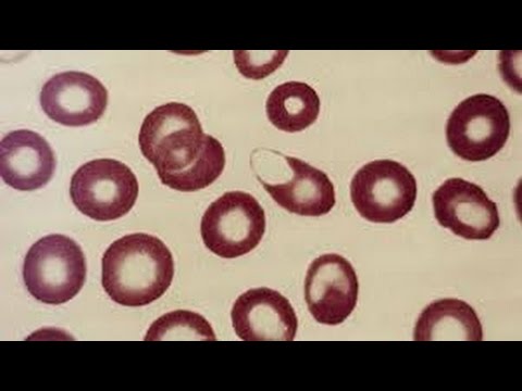 ANEMIA HEMOLÍTICA - DISMINUCIÓN DE GLÓBULOS ROJOS EN ...