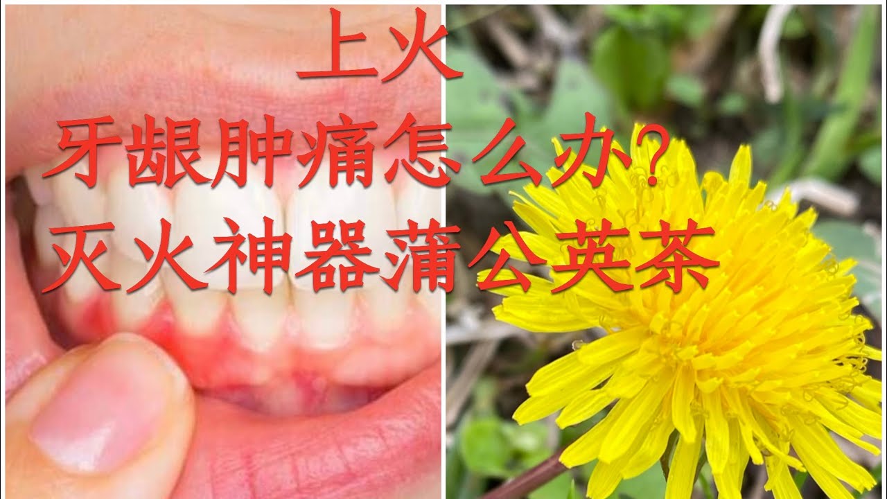 蒲公英茶，常备的”灭火消肿止痛”神器 Drinking dandelion tea is effective if you suffer