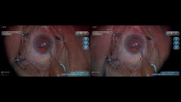 3D Surgery: Basics of Phacoemulsification: Cortex Removal (Part 5/6)