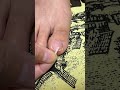 Toe Nail Fixer| Ingrown Toenail Cleaning & Care #ToenailFix #NailCare #FootCare #PedicureClean
