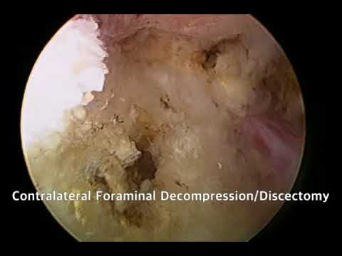 http://pixvid.me/mdbonedocsSpinalStenosis The lower back is a common place to experience pain and di. 
