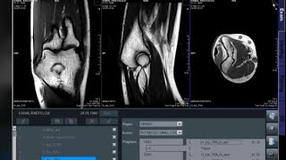 Dirsek Mr Nasıl Çekilir? K Radyoloji̇ Mr Çekmeyi Öğreniyorum Siemens Magnetom Essenza