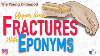 Named Fractures: UPPER LIMB, Fractures with EPONYMS, NEET PG, The Young Orthopod