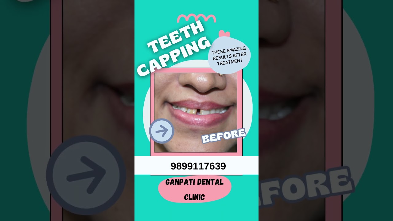 Transform Your Smile with Expert Dental Capping!