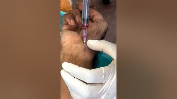 ABG technique Radial artery  #norcet #nursing #knowledge #medical #abg