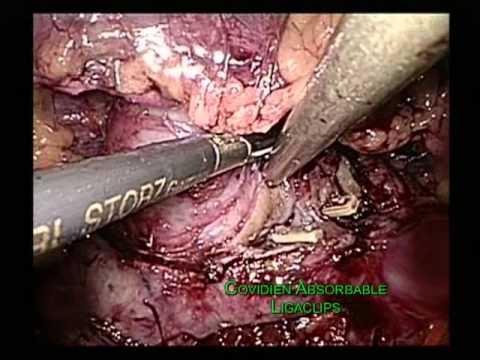 Retroperitoneoscopic Partial Nephrectomy