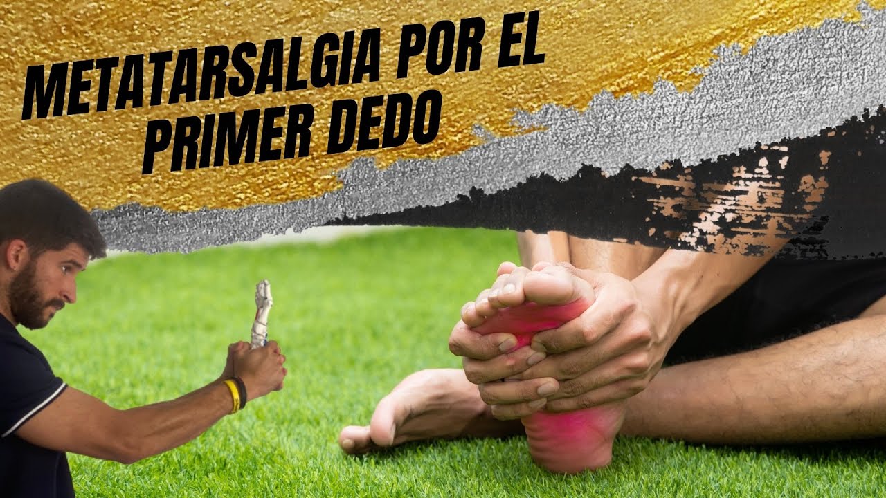 METATARSALGIA POR HIPERMOVILIDAD DEL PRIMER RADIO - YouTube