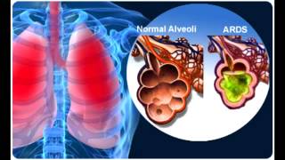 Acute Respiratory Distress Syndrome (ARDS)