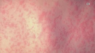 Iowa's measles vaccination rate below what's needed to stop spread, spring break could pose risk