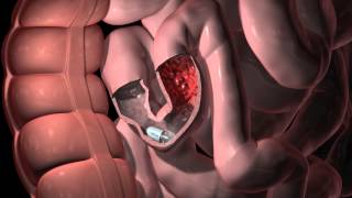 Pillcam Sb 3 Animation - Gi Tract Abnormalities