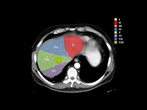 segmentación hepática