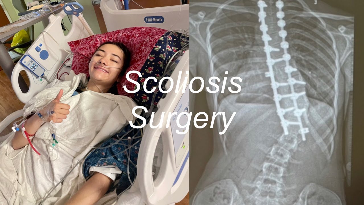 Scoliosis Surgery Vlog: recovery & awareness!