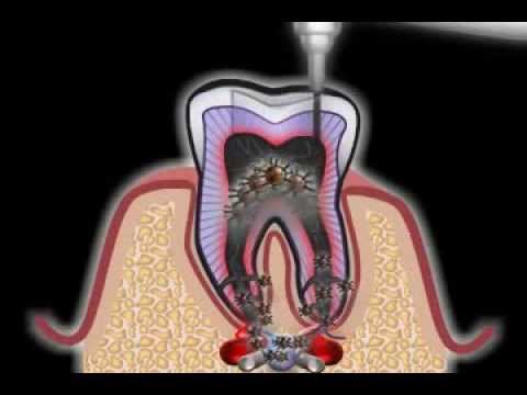 Wurzelbehandlung Beim Zahnarzt Youtube