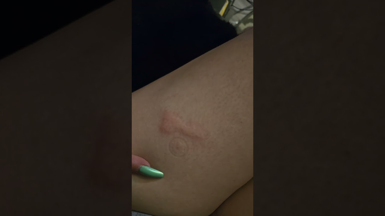 NEW Xolair Autoinjector And 300mg dose HOW-TO