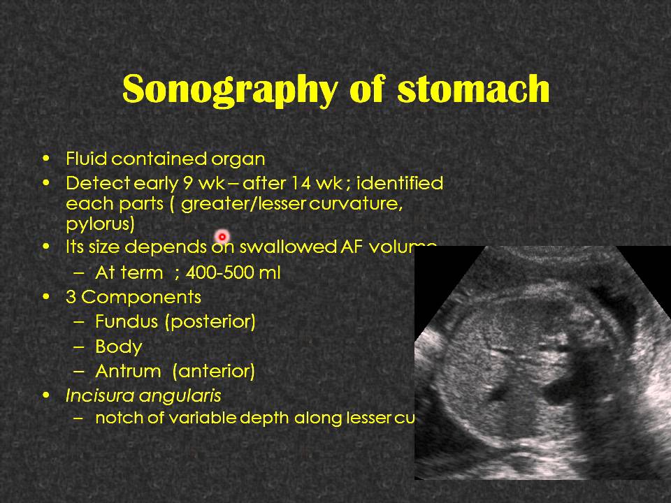 CASE 79 FETAL GASTRIC SHADOW Dr AHMED ESAWY