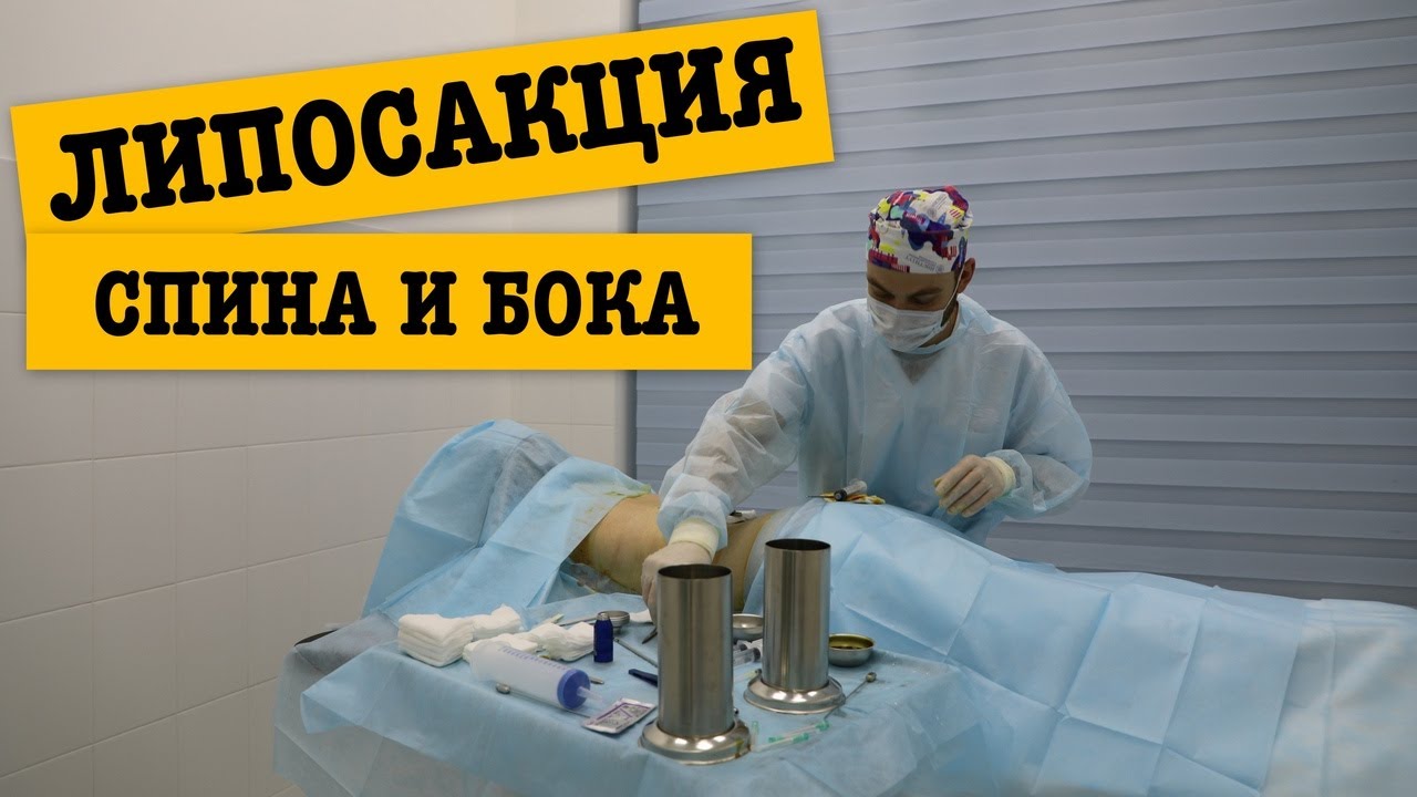 Липосакция."Брителечный" жир и бока - YouTube