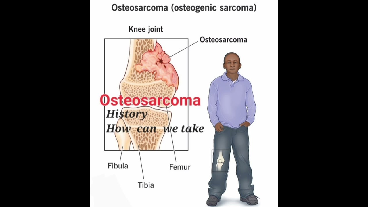 Osteosarcoma  History  
