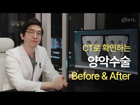 Double jaw before and after seen on CT
