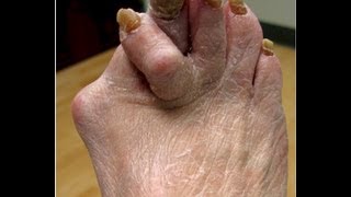 Nasty Foot