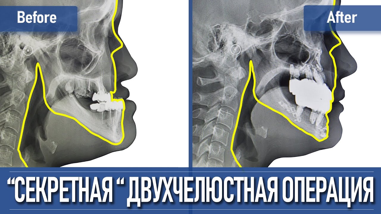 Исправление прикуса - двухчелюстная операция в Корее