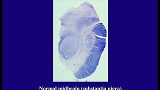 Pathology of Dementia, Degenerative and Spinal Cord Diseases