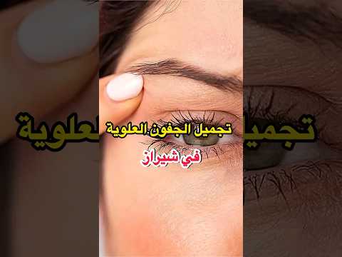 عملية شدالجفون العلوية في شيراز سنا و زهیر العراقي مترجمين في شيراز ابلور ترند شد الجفون
