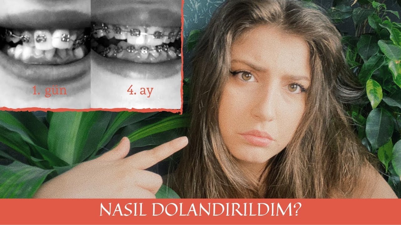 DİŞ TELİ SÜRECİM, NASIL DOLANDIRILDIM?
