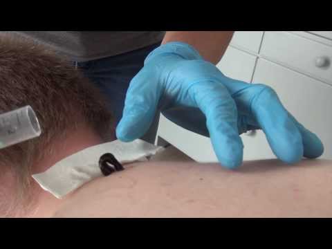 Video: Hoito Iileillä (hirudoterapia) - Vaihtoehtoinen Näkymä