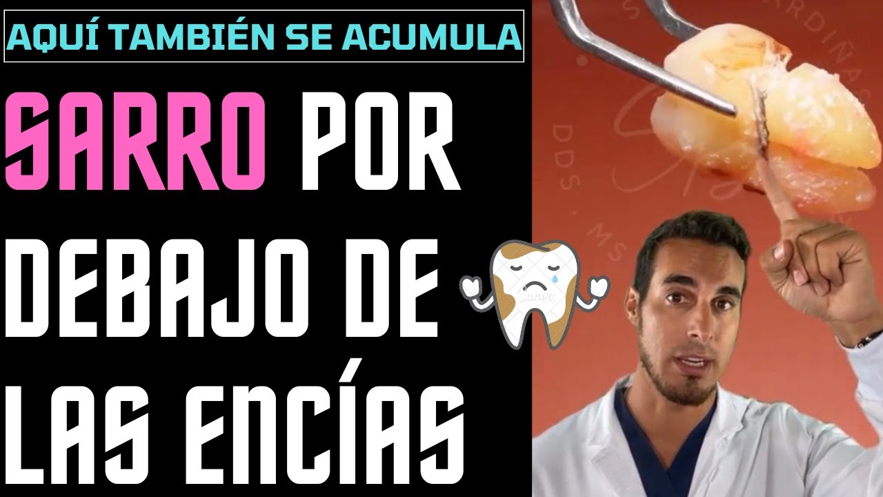 Sarro Debajo De Las Encías El SARRO DENTAL también se acumula por debajo de las ENCÍAS - Esto te