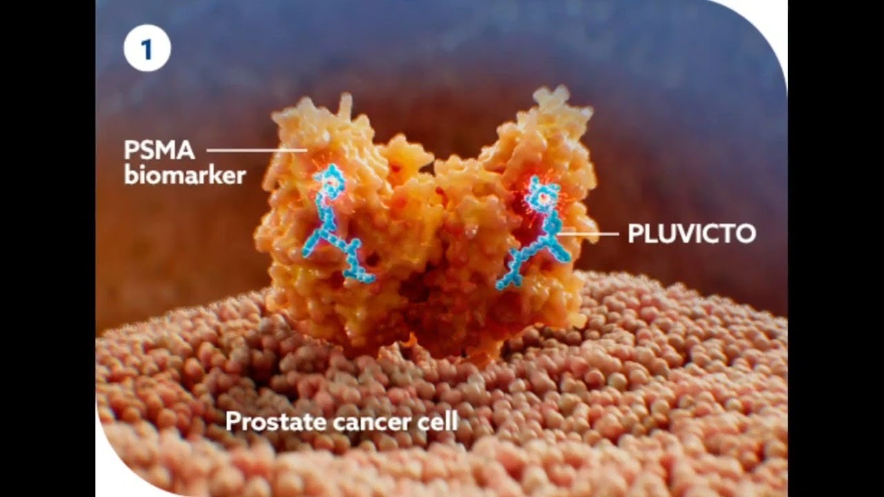 PSA test can help in early detection of prostate cancer